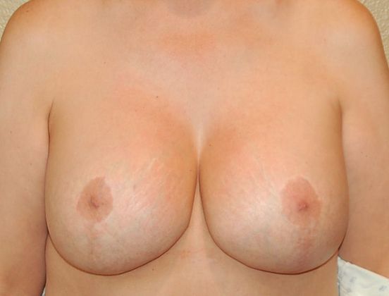 Breast Augmentation Case 380 - After