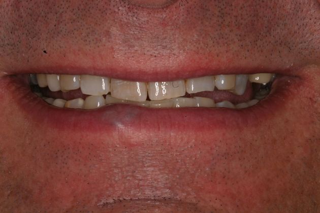 Porcelain Veneers Case 16 - Before