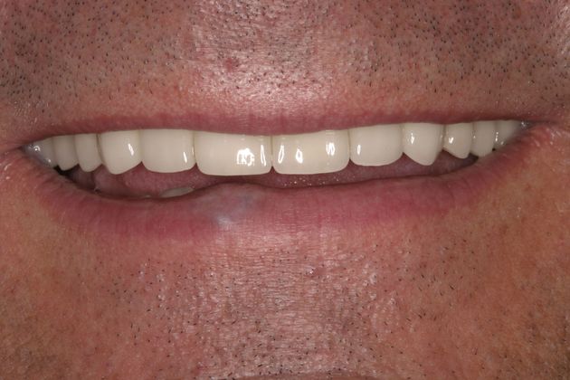 Porcelain Veneers Case 16 - After