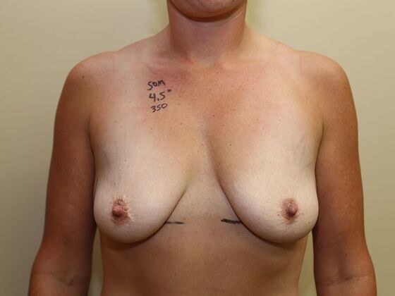 Breast Lift & Implants Case 3 - Before