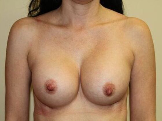 Breast Augmentation: Case 11 - After