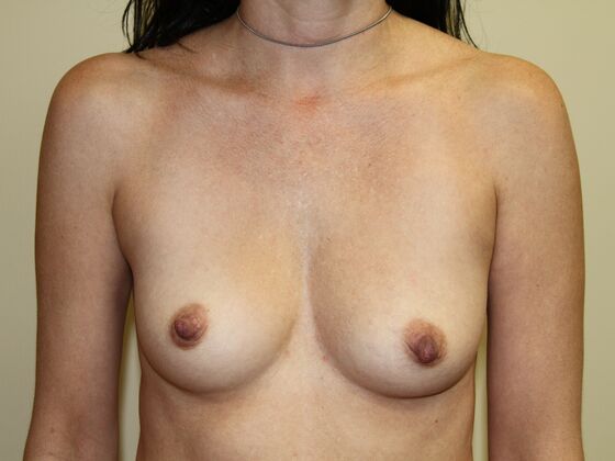 Breast Augmentation: Case 11 - Before