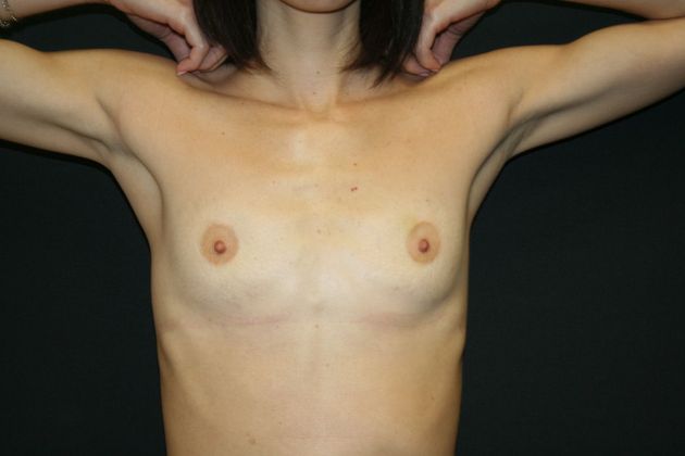 Breast Augmentation Case 19 - Before