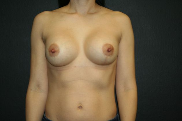 Mastopexy Case 15 - After