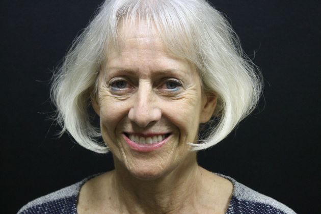 Facelift Case 14 - Before