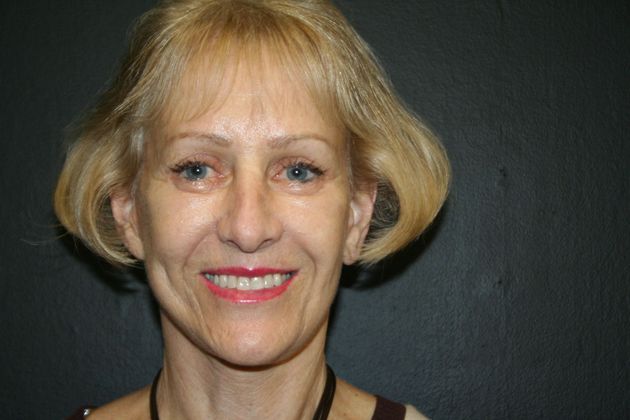 Facelift Case 14 - After