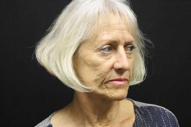 Facelift: Case 14 - Before 
