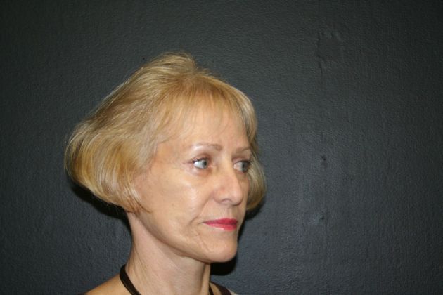 Facelift: Case 14 - After