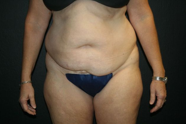 Abdominoplasty Case 12 - Before