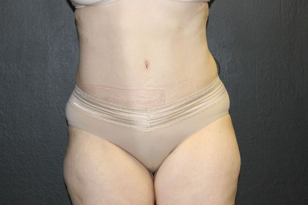 Abdominoplasty Case 12 - After