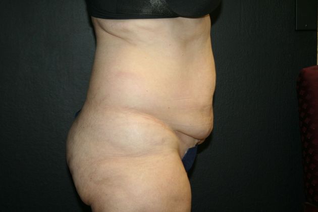 Abdominoplasty: Case 12 - Before 