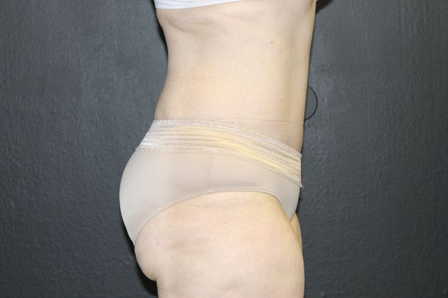 Abdominoplasty: Case 12 - After