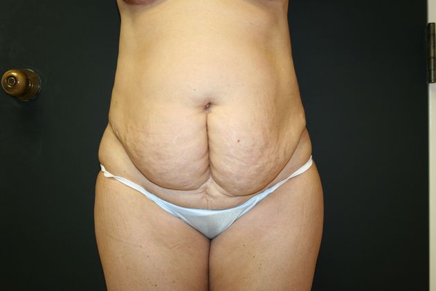 Abdominoplasty Case 13 - Before