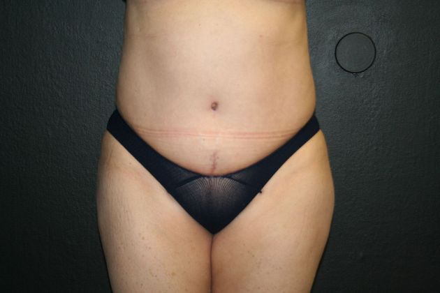 Abdominoplasty Case 13 - After