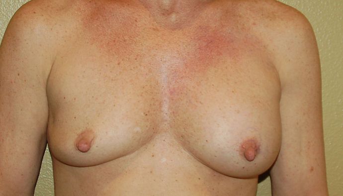Breast Revision: Case 67 - Before