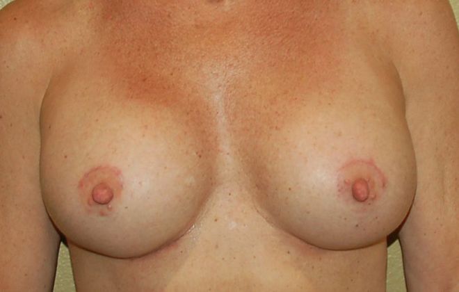 Breast Revision: Case 67 - After