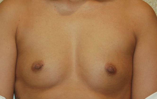 Breast Augmentation Case 382 - Before
