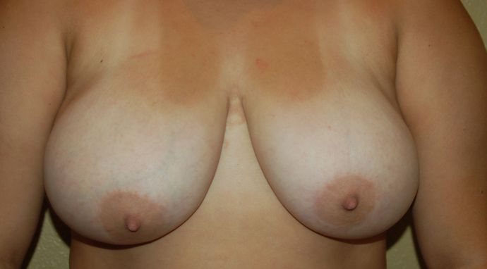 Breast Reduction Case 34 - Before