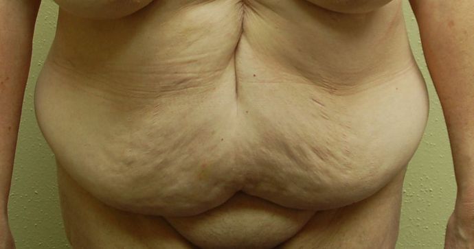 Massive Weight Loss : Case 30 - Before