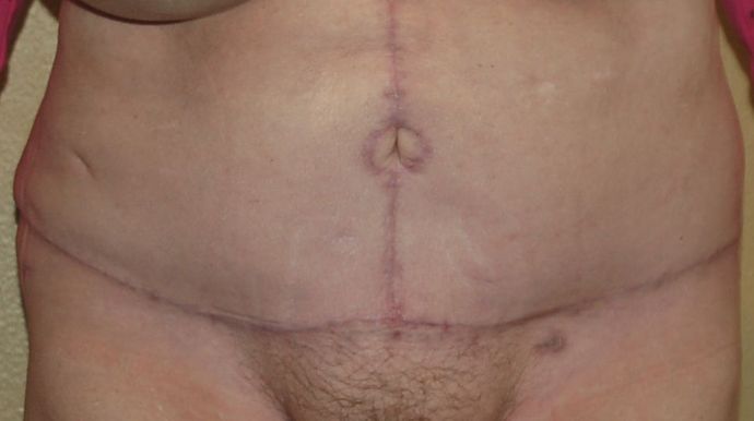 Massive Weight Loss : Case 30 - After