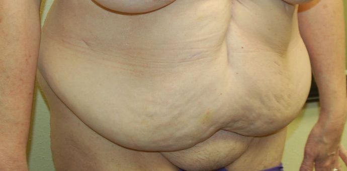 Massive Weight Loss : Case 30 - Before