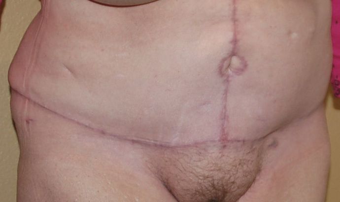 Massive Weight Loss : Case 30 - After