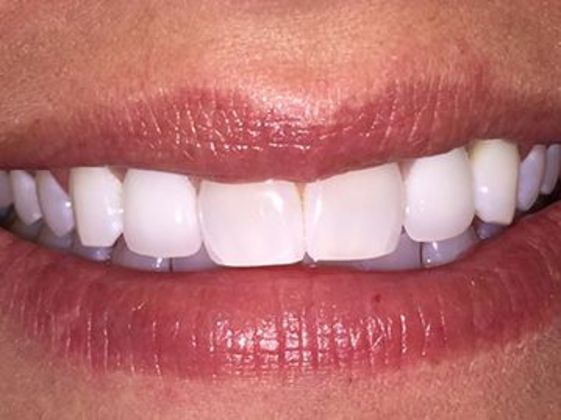 Smile Makeovers: Case 18 - After