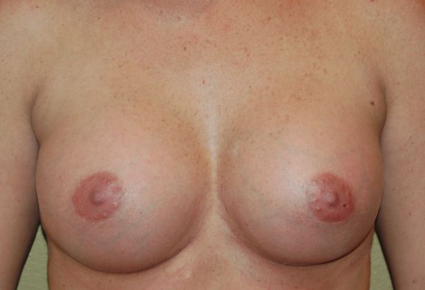 Breast Augmentation Case 387 - After