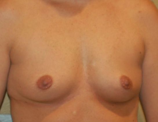 Breast Augmentation: Case 387 - Before