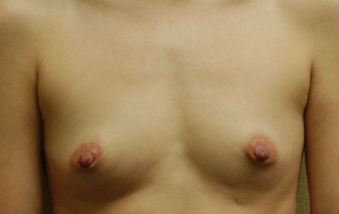 Breast Augmentation Case 388 - Before