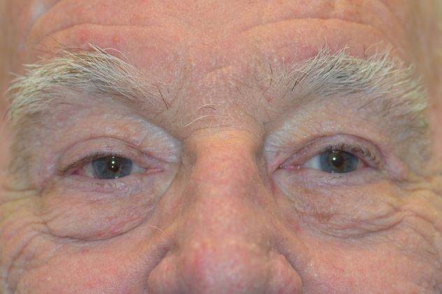 Upper Eyelid Blepharoplasty: Case 51 - After