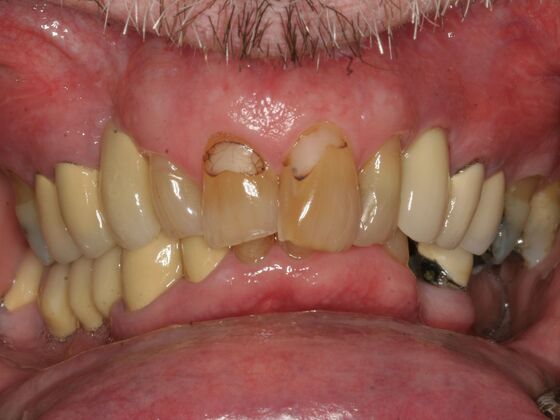 All-on-4 Dental Implants Case 3: Bergenfield, NJ - Before