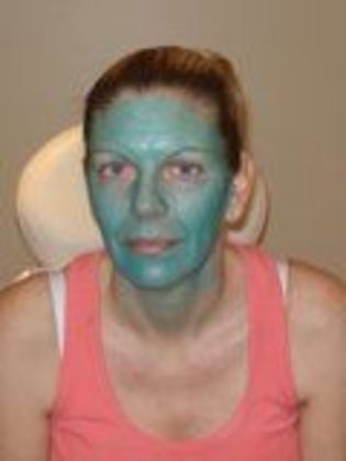 Obagi Blue Peel Case 7 - After