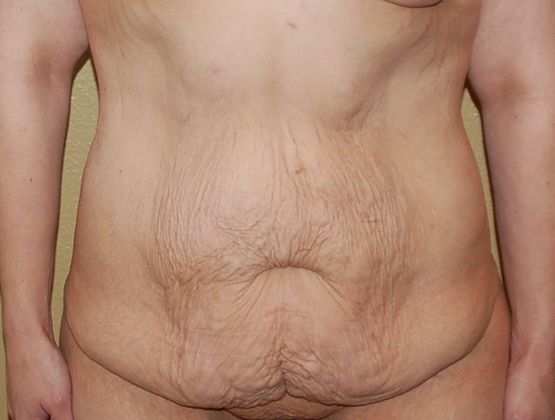 Massive Weight Loss : Case 31 - Before