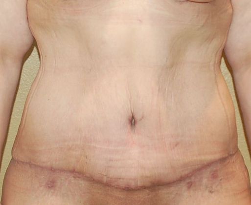 Massive Weight Loss : Case 31 - After