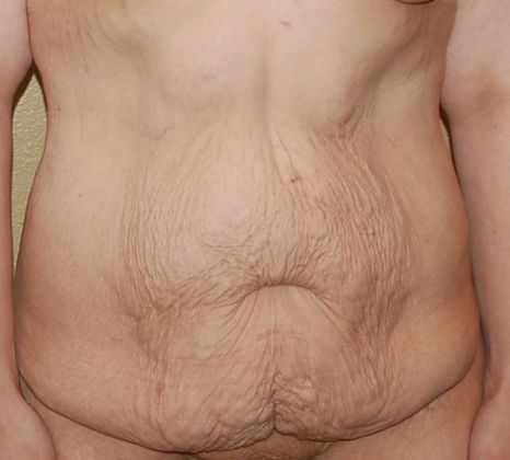 Massive Weight Loss : Case 31 - Before