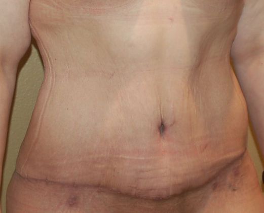 Massive Weight Loss : Case 31 - After