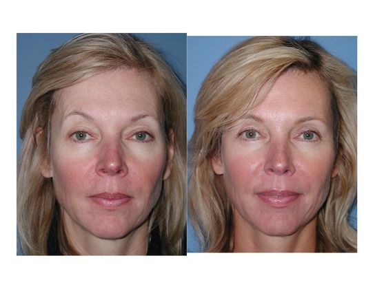 Blepharoplasty: Case 1