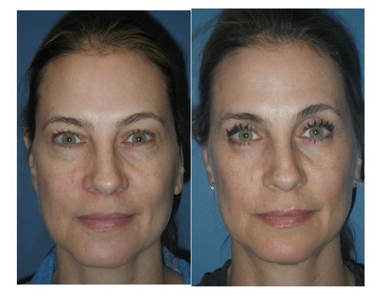 Blepharoplasty Case 3