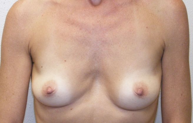 Breast Reconstruction Case 58 - Before