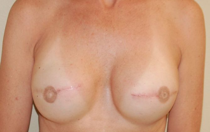 Breast Reconstruction Case 58 - After