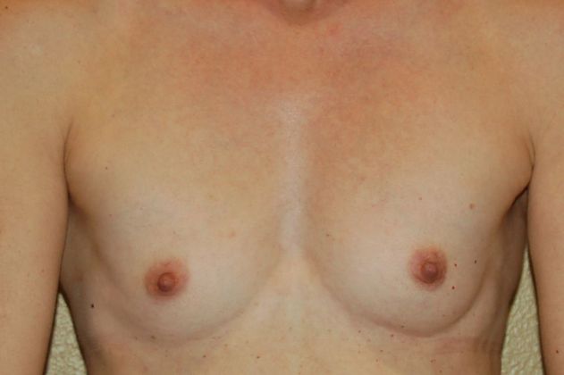 Breast Augmentation Case 392 - Before