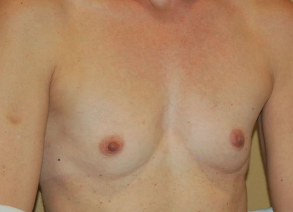 Breast Augmentation: Case 392 - Before