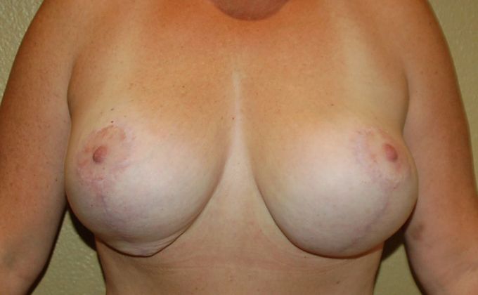 Breast Revision: Case 70 - Before