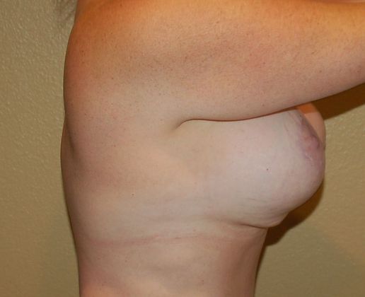 Breast Revision: Case 70 - Before