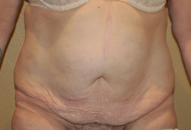 Massive Weight Loss  Case 33 - Before
