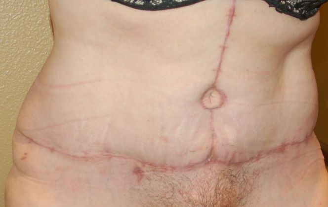 Massive Weight Loss  Case 33 - After