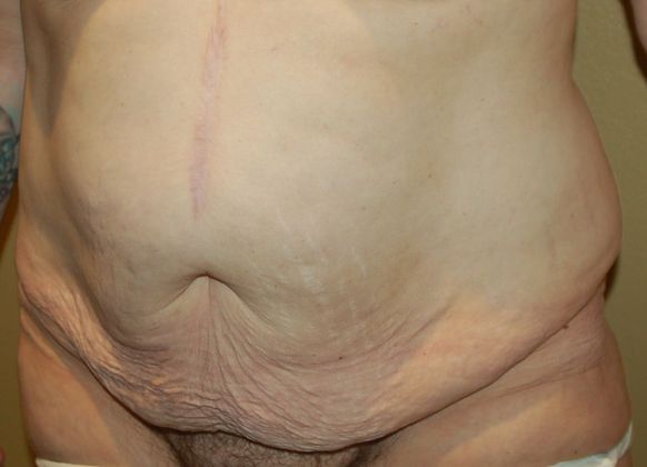 Massive Weight Loss : Case 33 - Before