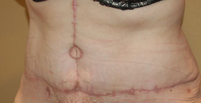 Massive Weight Loss : Case 33 - After