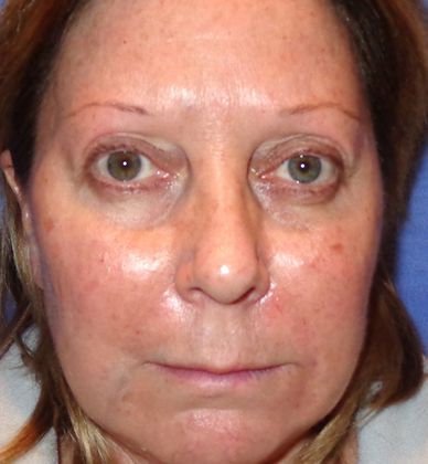 Soft Tissue Fillers Case 10 - Before